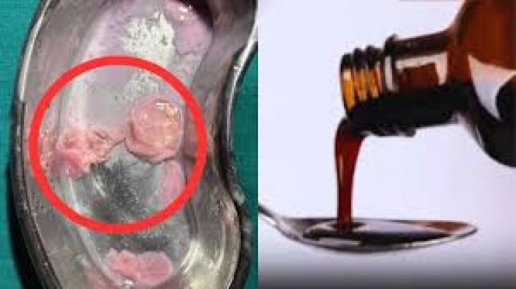 सीरप की बोतल में संदिग्ध वस्तु मिलने का मामला, जांच के लिए नमूने भेजे गए राज्य औषधि परीक्षण प्रयोगशाला