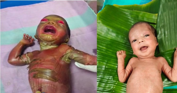 सुदूर बीजापुर में चिकित्सा चमत्कार : अत्यंत दुर्लभ बीमारी से जूझते शिशु को बचाया